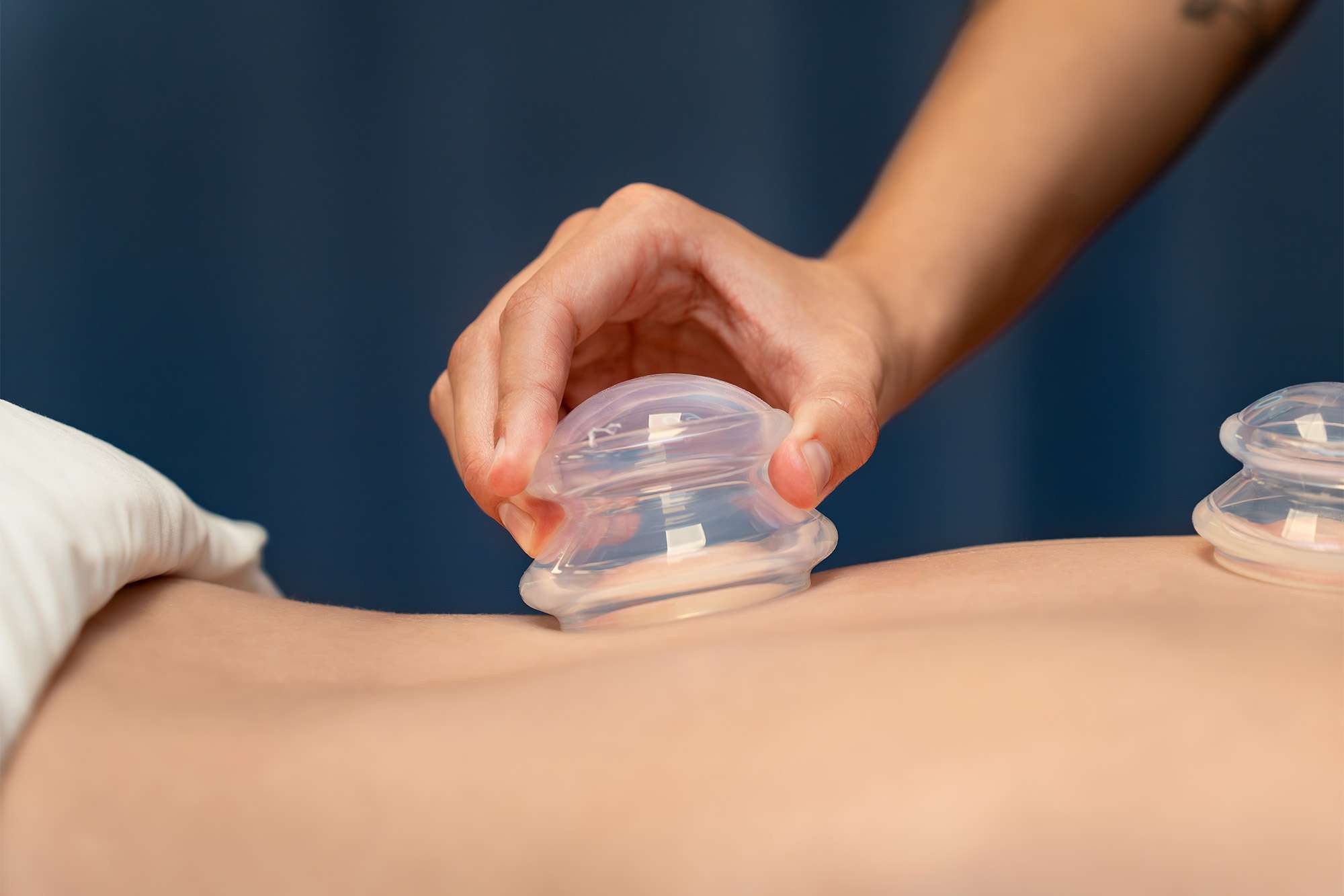 A massage therapist is using suction cups for Cupping therapy on a patient.